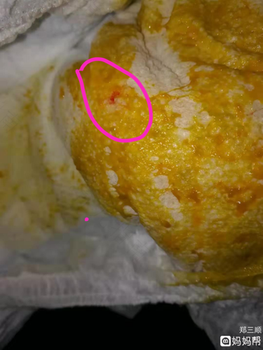 大便出血块怎么回事? 大便出血块怎么回事?