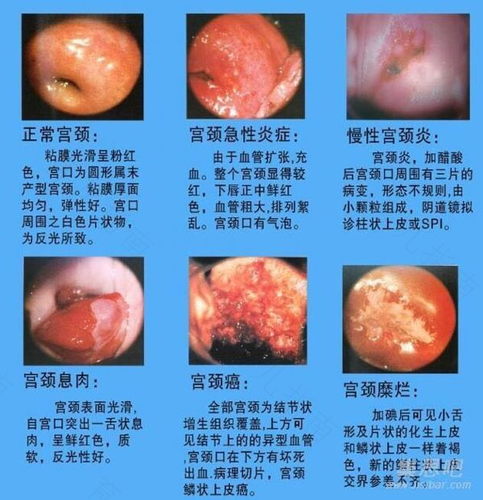 宫颈糜烂咋引起的原因 宫颈糜烂咋引起的原因