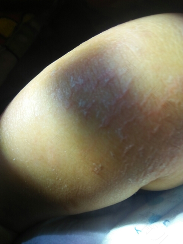 月子里身上掉皮怎么办 月子里身上掉皮怎么办