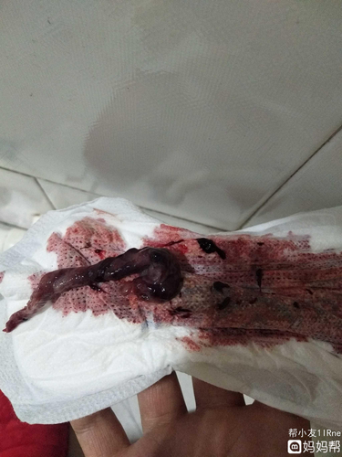 便血之后肚子疼是怎么回事 便血之后肚子疼是怎么回事