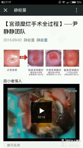 宫颈糜烂自己怎么判断轻重