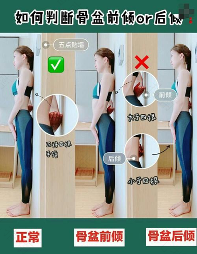 骨盆前倾自己能矫正吗 骨盆前倾自己能矫正吗