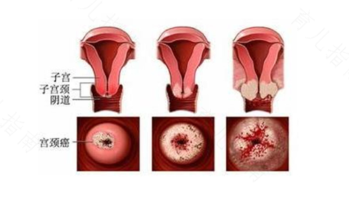宫颈破皮了几天能好