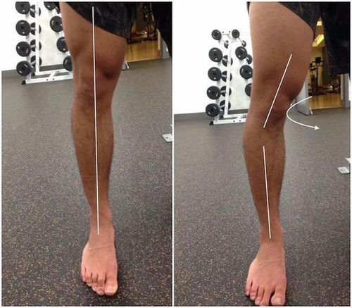 怎么把o型腿练得笔直 怎么把o型腿练得笔直