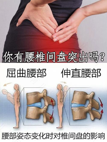腰间盘突出怎么治疗能根除 腰间盘突出怎么治疗能根除