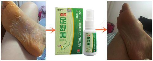 怎么治疗脚气最有效的方法 怎么治疗脚气最有效的方法