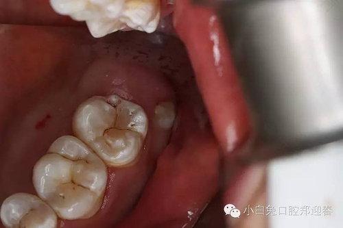 一般拔牙麻药多久失效 一般拔牙麻药多久失效