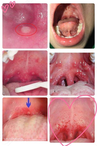 疱疹性咽峡炎会拉肚子吗 疱疹性咽峡炎会拉肚子吗