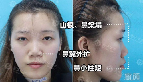 鼻软骨发育不全怎么办 鼻软骨发育不全怎么办