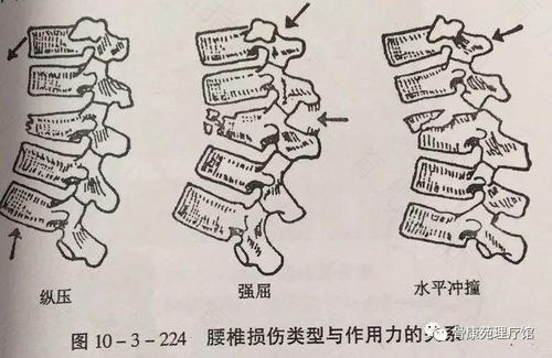 腰椎横突骨折错位怎么办 腰椎横突骨折错位怎么办
