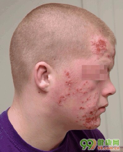 男性艾滋病的早期症状图片 男性艾滋病的早期症状图片