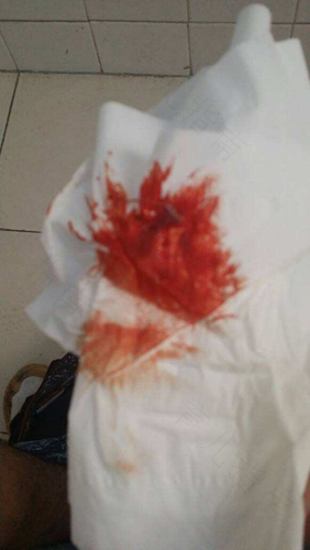 胃出血是什么原因引起的