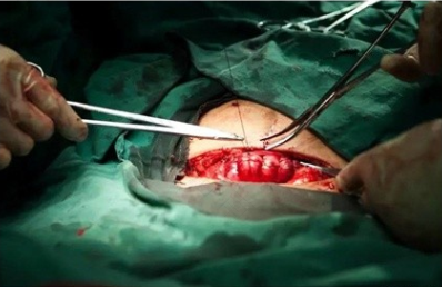 顺产撕裂的伤口裂开了怎么办 顺产撕裂的伤口裂开了怎么办