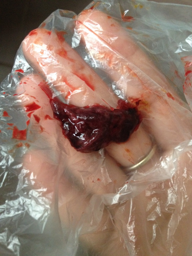 人流是什么样的过程