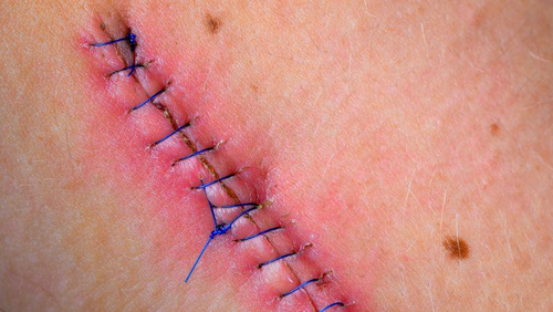 缝针周围水肿了怎么办 缝针周围水肿了怎么办