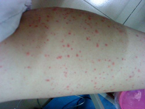 感冒发烧后起疹子怎么办 感冒发烧后起疹子怎么办