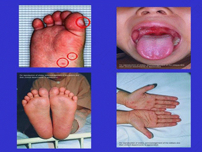 小孩手足口病是什么症状 初期 小孩手足口病是什么症状 初期