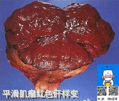 宫颈多发囊性结节严重吗