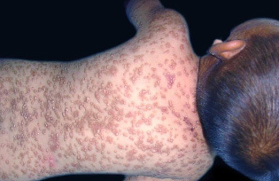 荨麻疹怎么样治疗能快一些 荨麻疹怎么样治疗能快一些