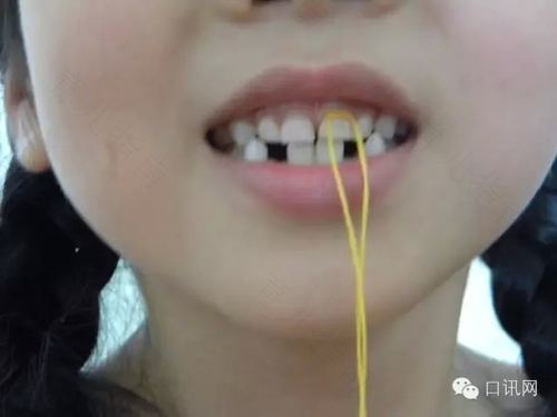 拔牙后牙疼怎么缓解疼痛 拔牙后牙疼怎么缓解疼痛