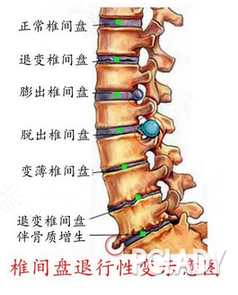 颈椎病会导致后背疼吗和头痛头晕 颈椎病会导致后背疼吗和头痛头晕