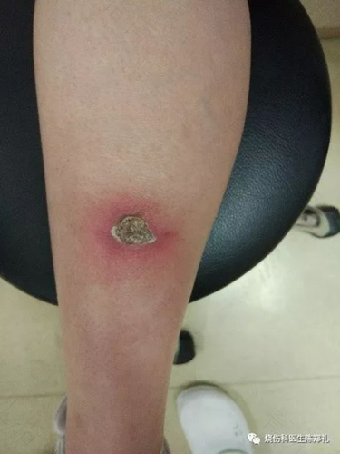 伤口周围痒是怎么回事 伤口周围痒是怎么回事