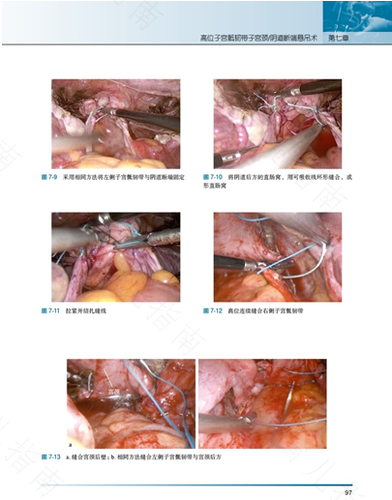 子宫直肠窝积液是怎么回事15mm