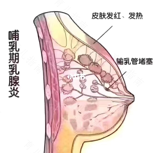 急性乳腺炎多久能好