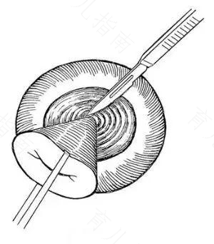 宫颈环切和锥切的区别图片 宫颈环切和锥切的区别图片