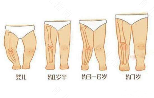 什么叫o型腿和x型腿 什么叫o型腿和x型腿