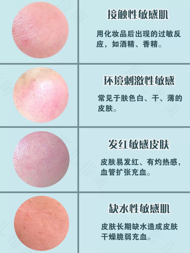 水过敏症状怎么引起的 水过敏症状怎么引起的