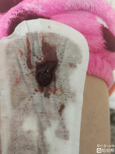 怀孕宫颈息肉为什么会出血 怀孕宫颈息肉为什么会出血