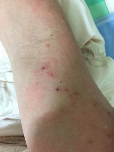 身上越挠越痒怎么回事怎么止痒 身上越挠越痒怎么回事怎么止痒