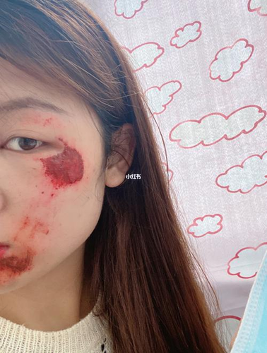 脸上擦伤留疤了怎么办 脸上擦伤留疤了怎么办