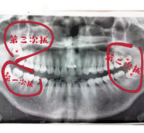 拔智齿第三天是最重吗 拔智齿第三天是最重吗