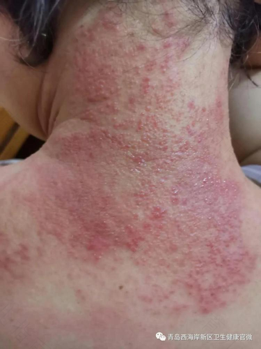 湿疹可以自行恢复吗 湿疹可以自行恢复吗