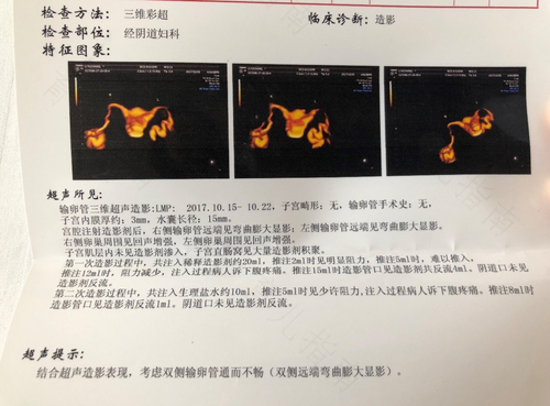 轻度输卵管积水怎么治疗