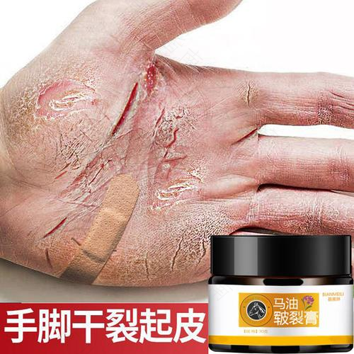 手脚皲裂严重怎么办 手脚皲裂严重怎么办