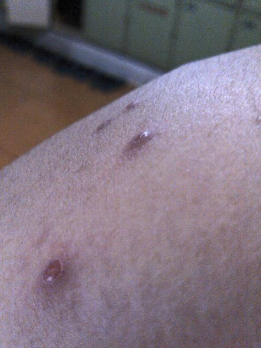 身体莫名的起疙瘩痒怎么回事 身体莫名的起疙瘩痒怎么回事