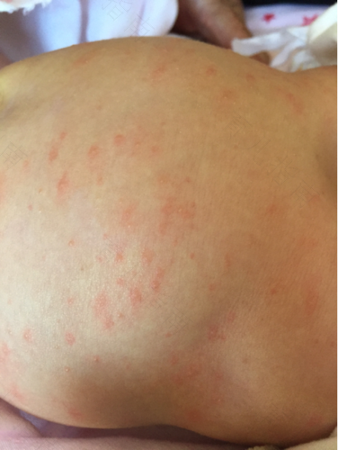 小孩的湿疹怎么治疗 小孩的湿疹怎么治疗