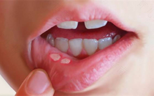 口腔溃疡能不能吃海鲜粥 口腔溃疡能不能吃海鲜粥