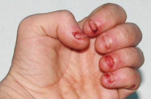 总咬手指甲是怎么回事 总咬手指甲是怎么回事
