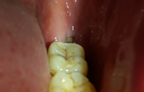 拔完牙第二天还会疼吗 拔完牙第二天还会疼吗