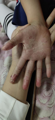 手上掉皮严重怎么回事 手上掉皮严重怎么回事