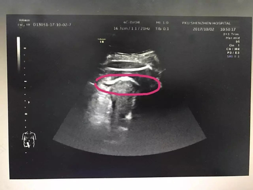 晚孕子宫破裂的超声表现 晚孕子宫破裂的超声表现