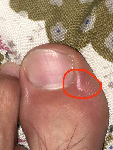 指甲边上的肉红肿疼痛怎么办? 指甲边上的肉红肿疼痛怎么办?