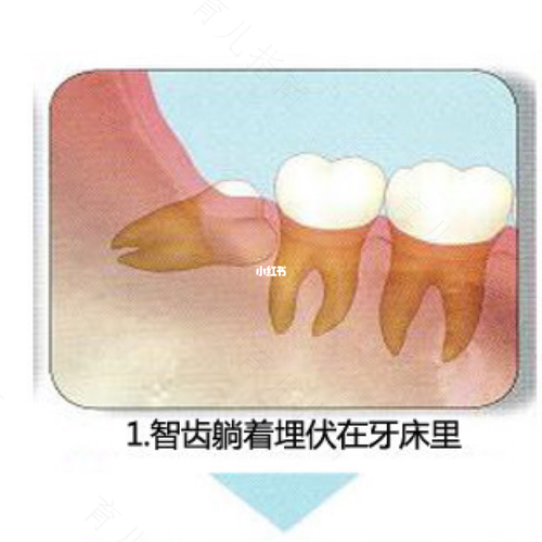 有智齿但是不疼需要拔吗 有智齿但是不疼需要拔吗