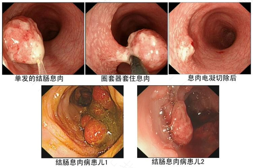 直肠息肉是怎么回事