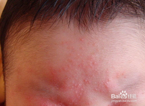 奶癣怎么治疗方法 奶癣怎么治疗方法