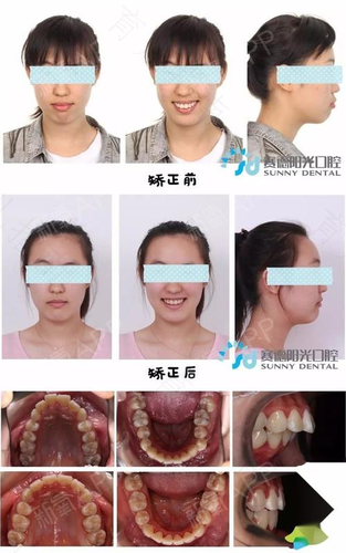 拔牙后种植好还是带牙套好 拔牙后种植好还是带牙套好